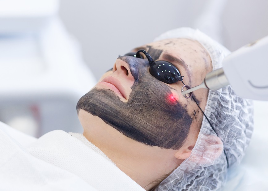 Carbon Laser Peel: Unveiling the Secret to Flawless Skin