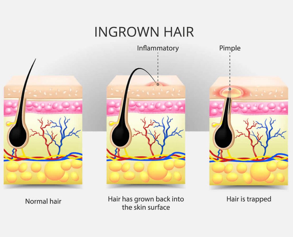 Unlock Smooth, Ingrown Hair-Free Skin with Advanced Laser Technology